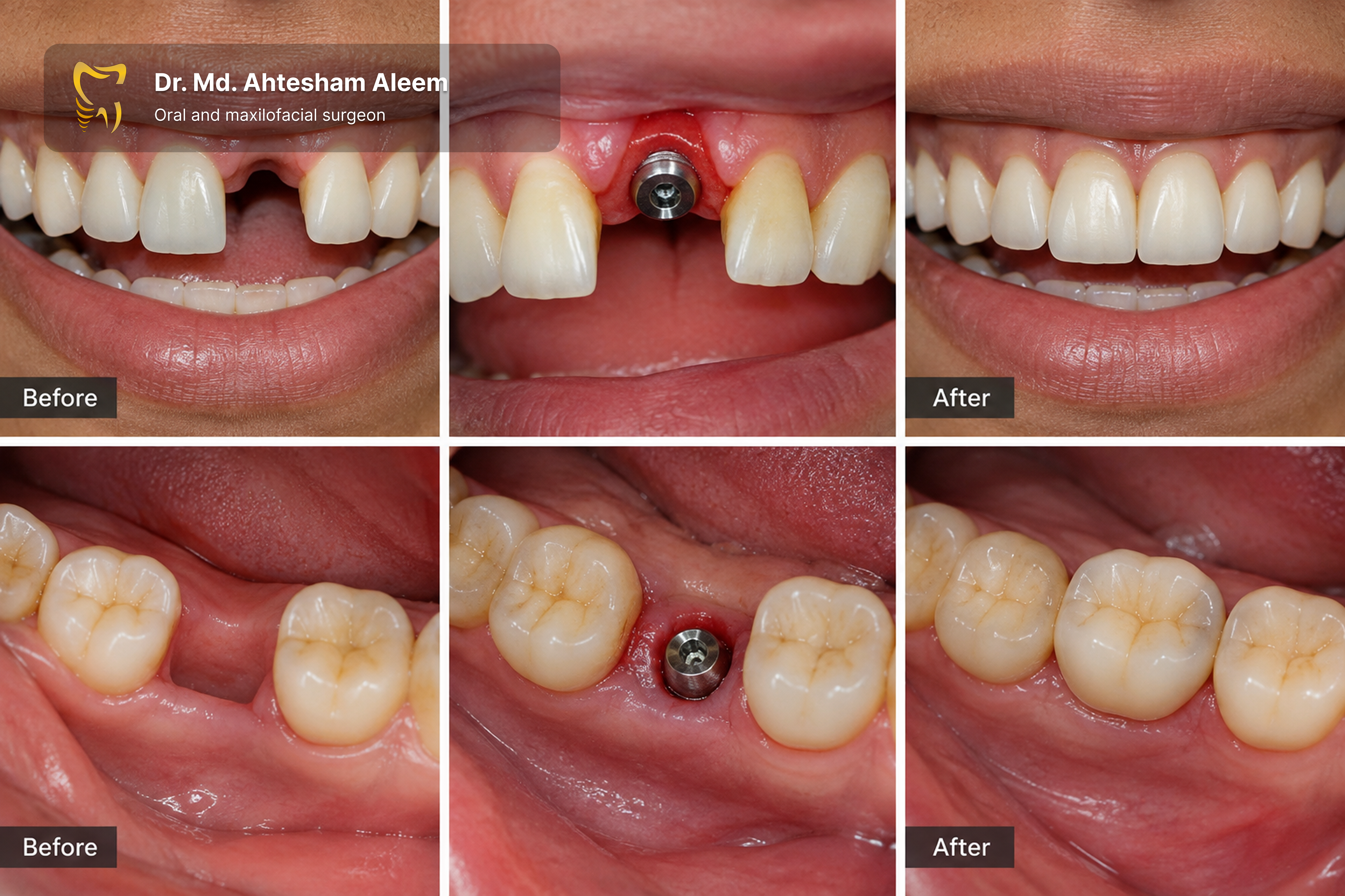 Immediate Implant Placement Gallery 1
