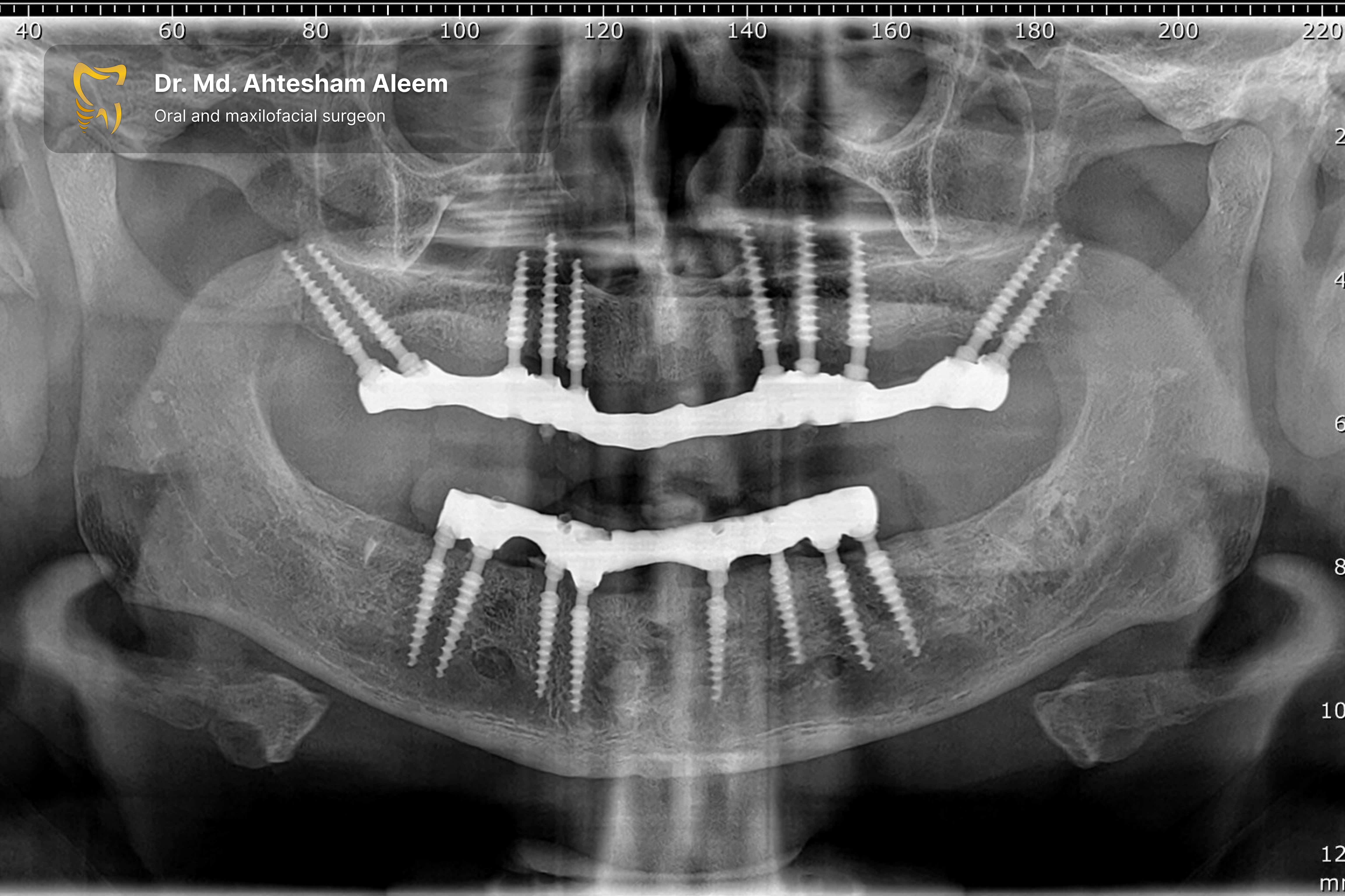 Full Mouth Rehabilitation with Dental Implants Gallery 2