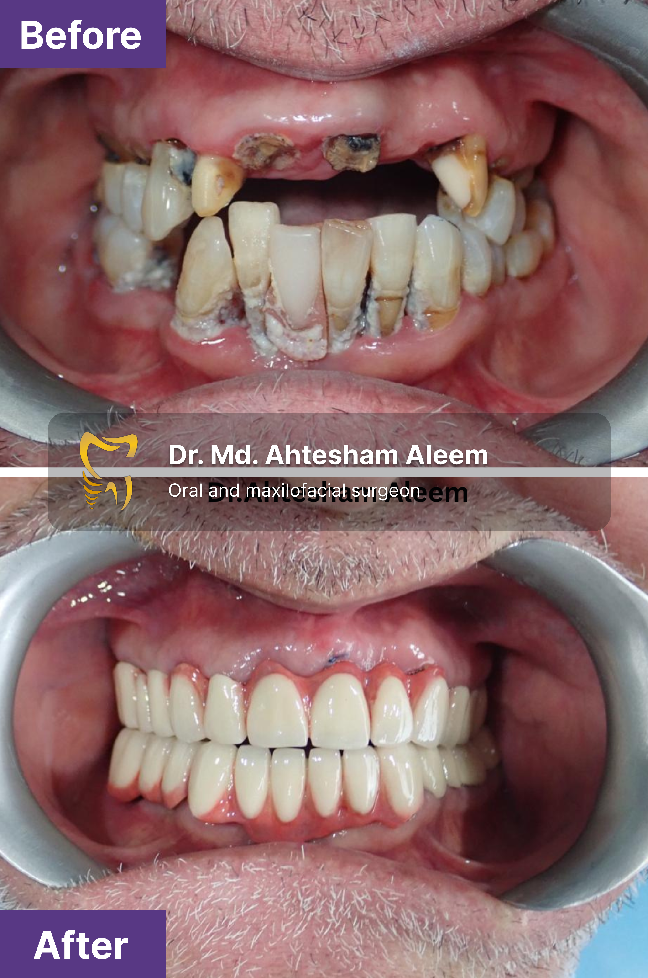 Full Mouth Rehabilitation with Dental Implants Gallery 11