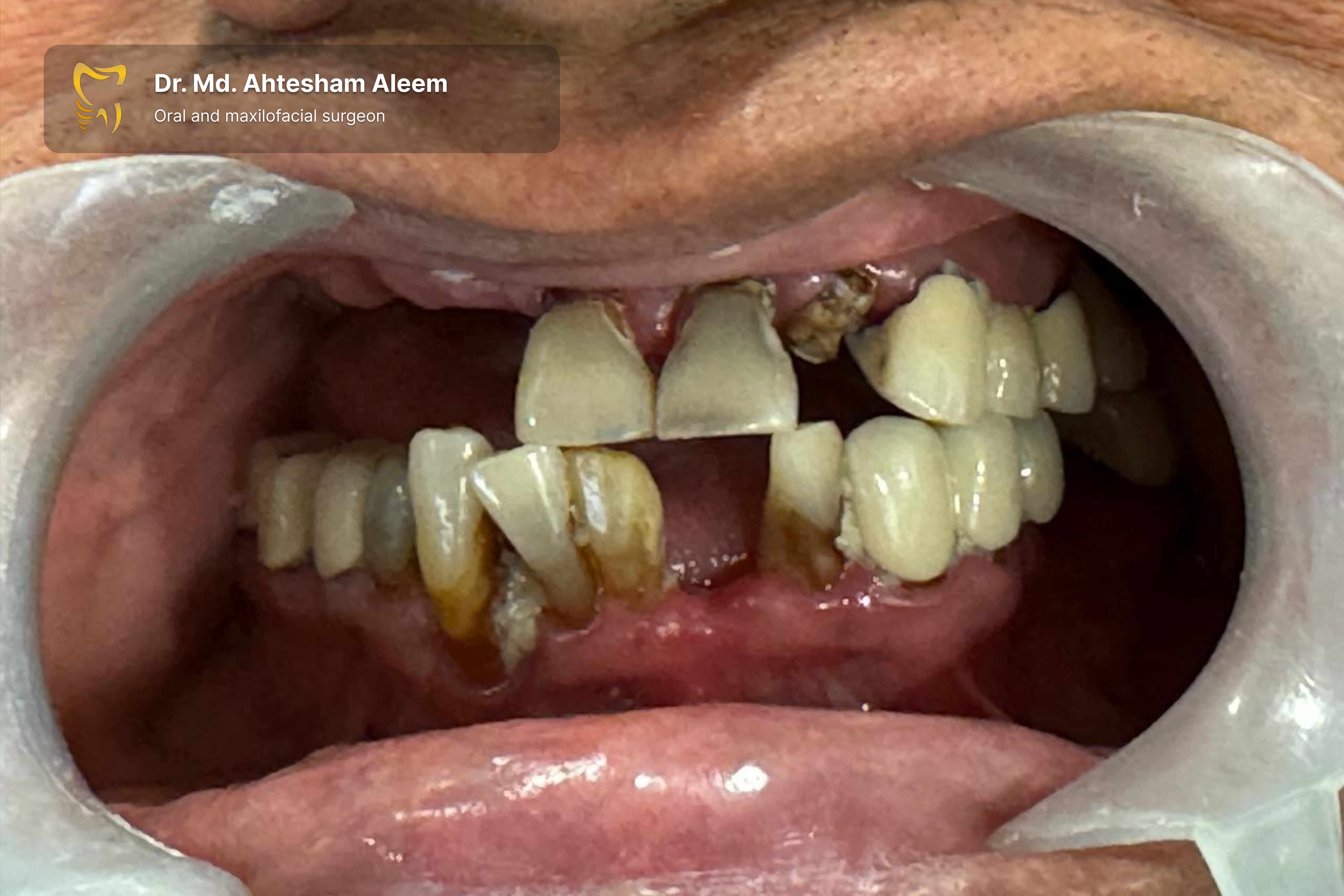 Full Mouth Rehabilitation with Dental Implants Gallery 3