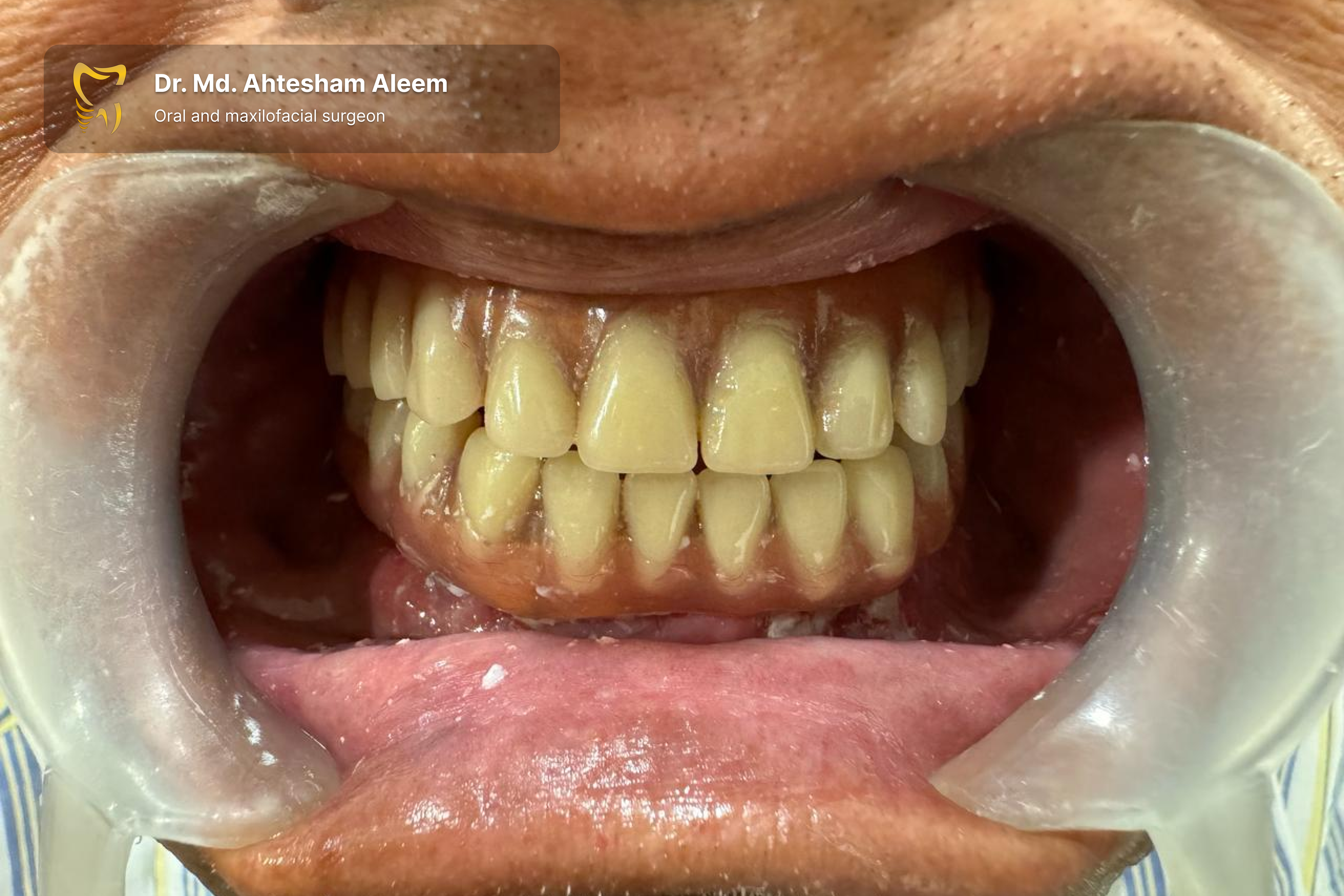 Full Mouth Rehabilitation with Dental Implants Gallery 4