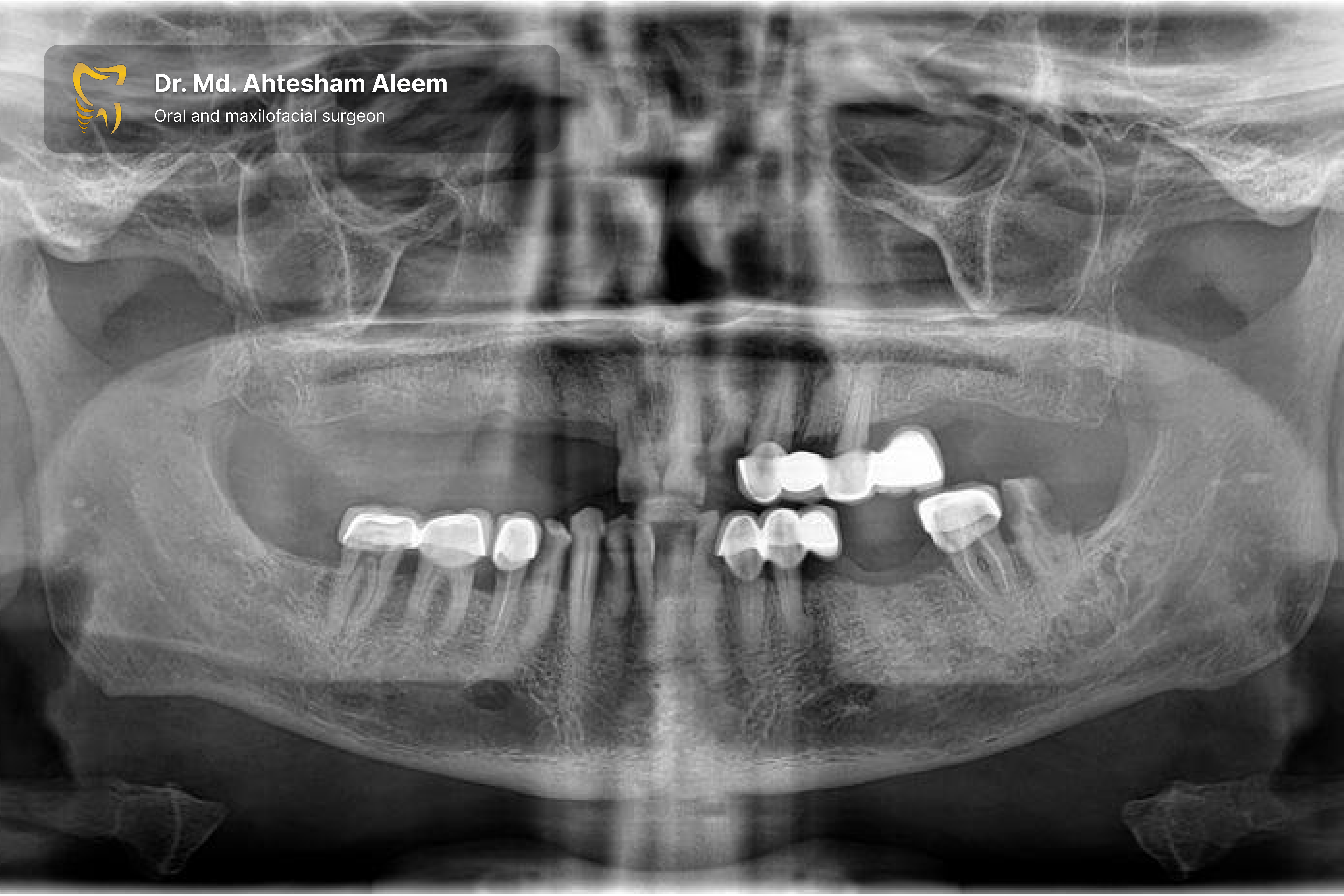 Full Mouth Rehabilitation with Dental Implants Gallery 5