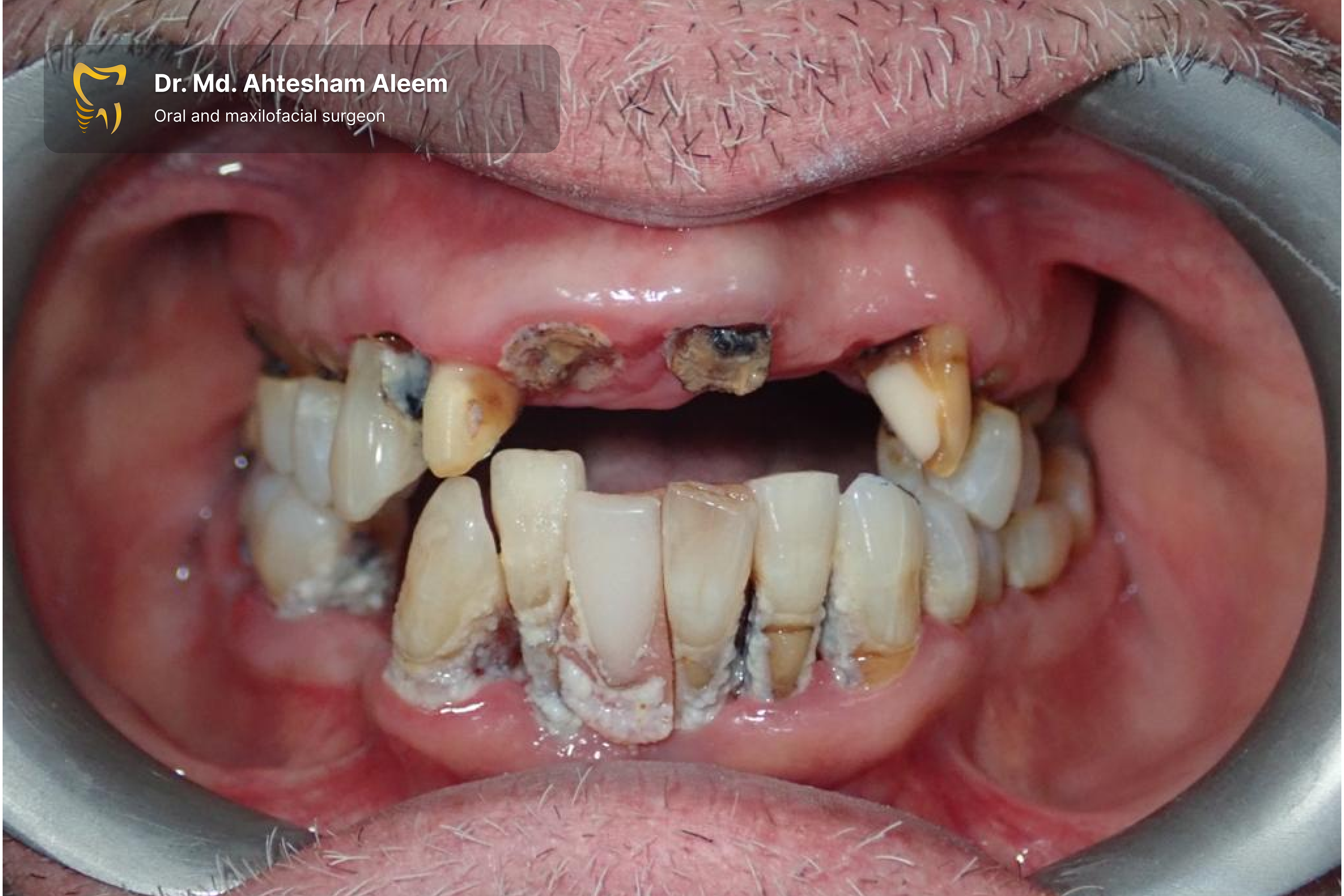 Full Mouth Rehabilitation with Dental Implants Gallery 6
