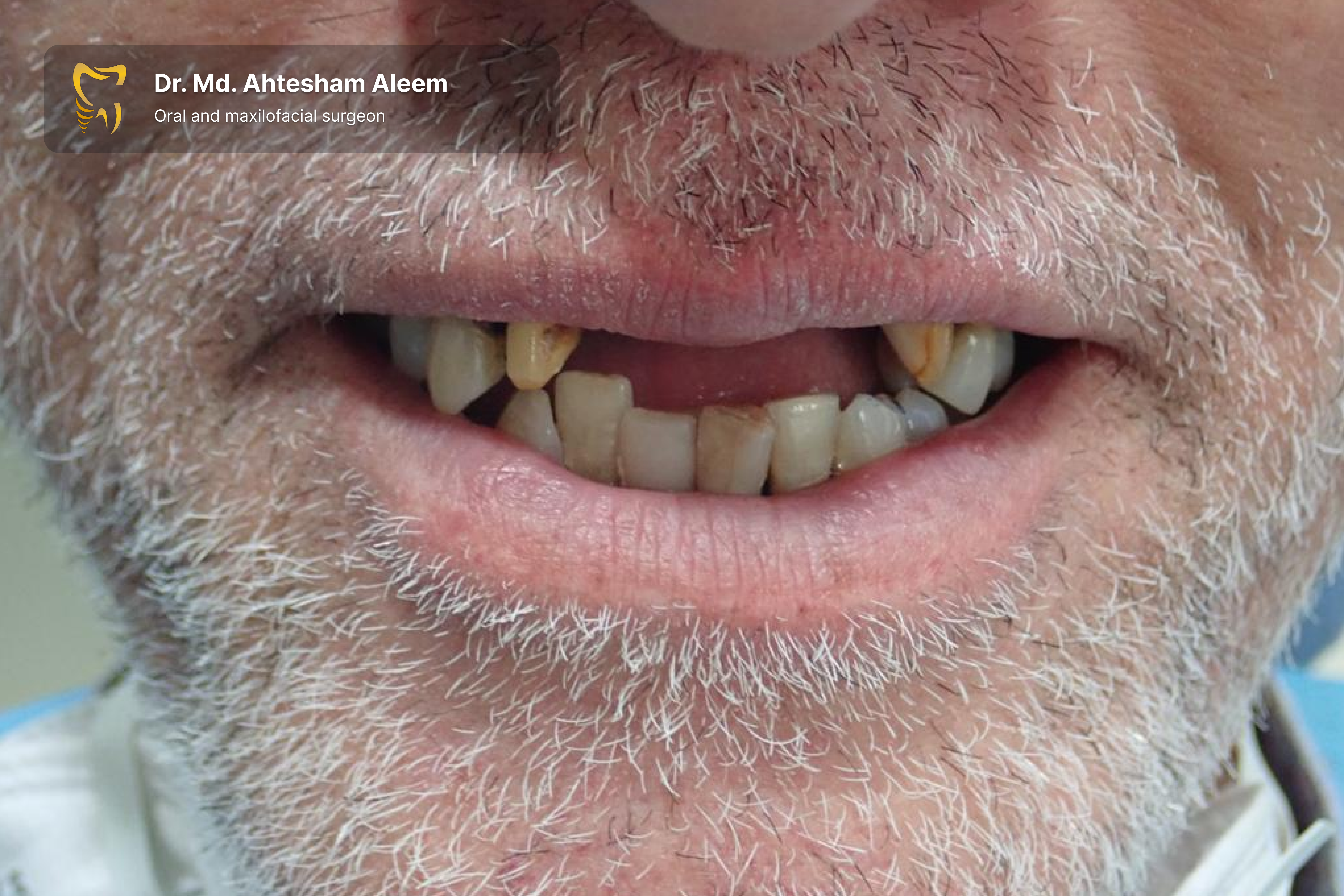 Full Mouth Rehabilitation with Dental Implants Gallery 7