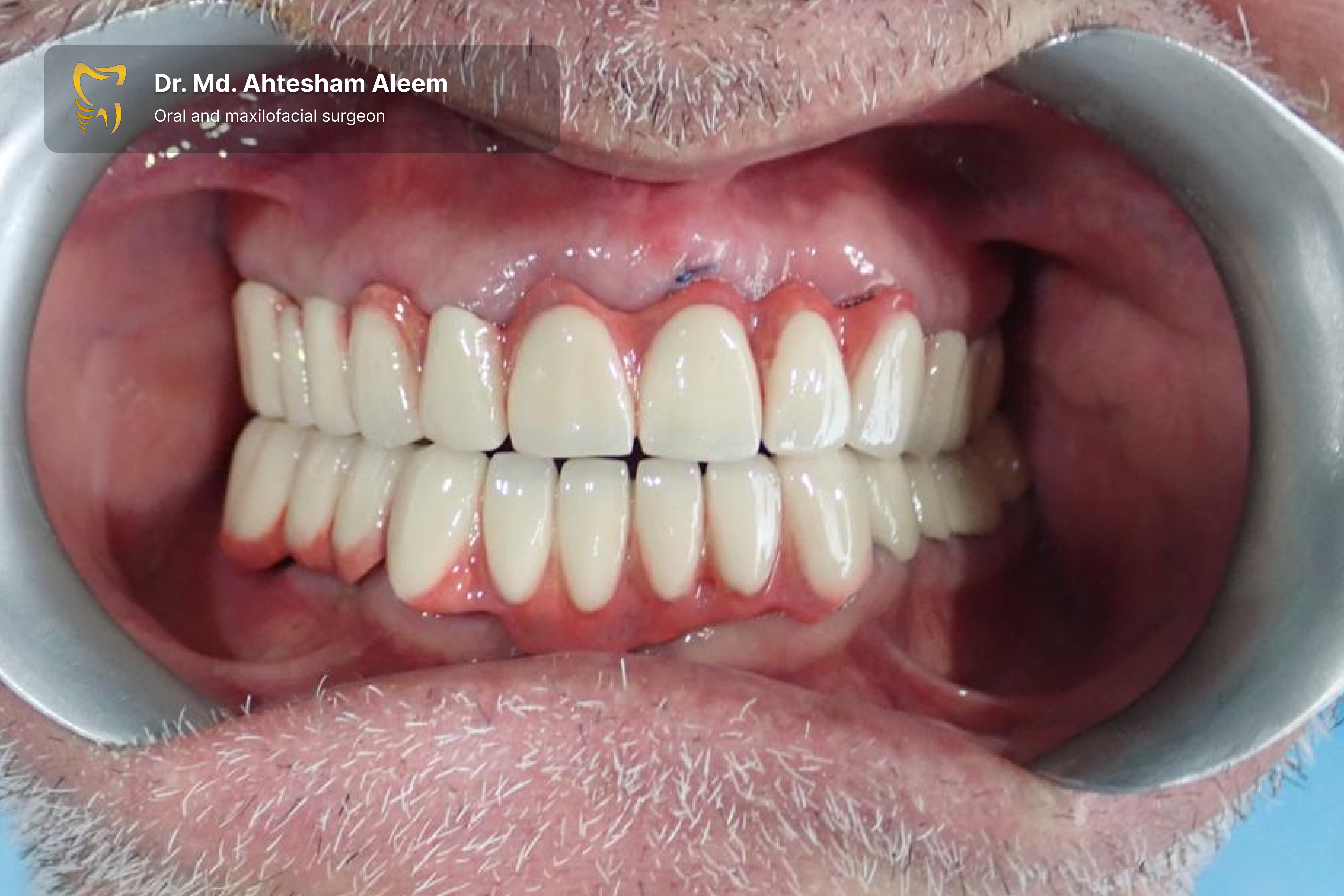 Full Mouth Rehabilitation with Dental Implants Gallery 8