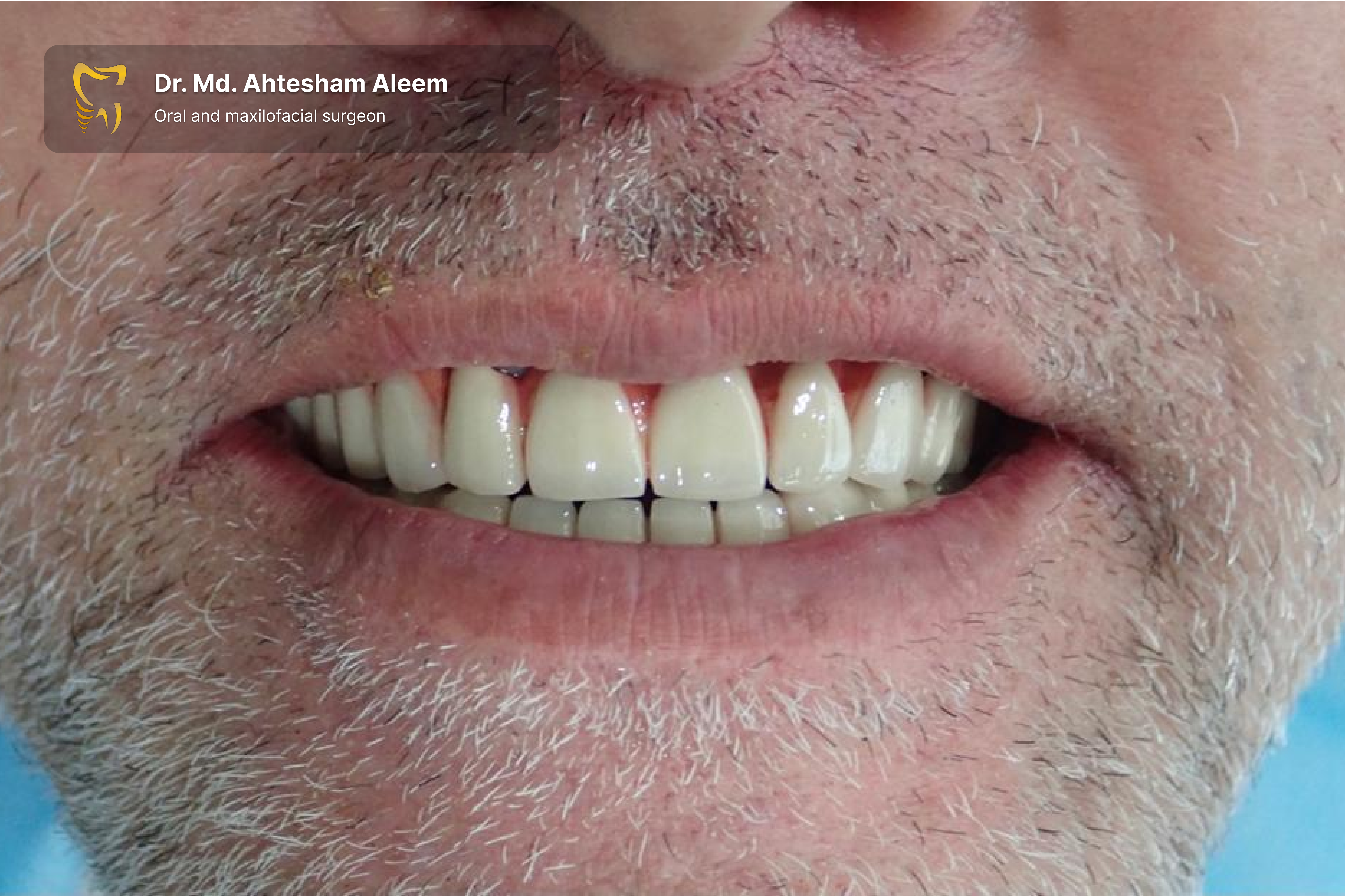 Full Mouth Rehabilitation with Dental Implants Gallery 9