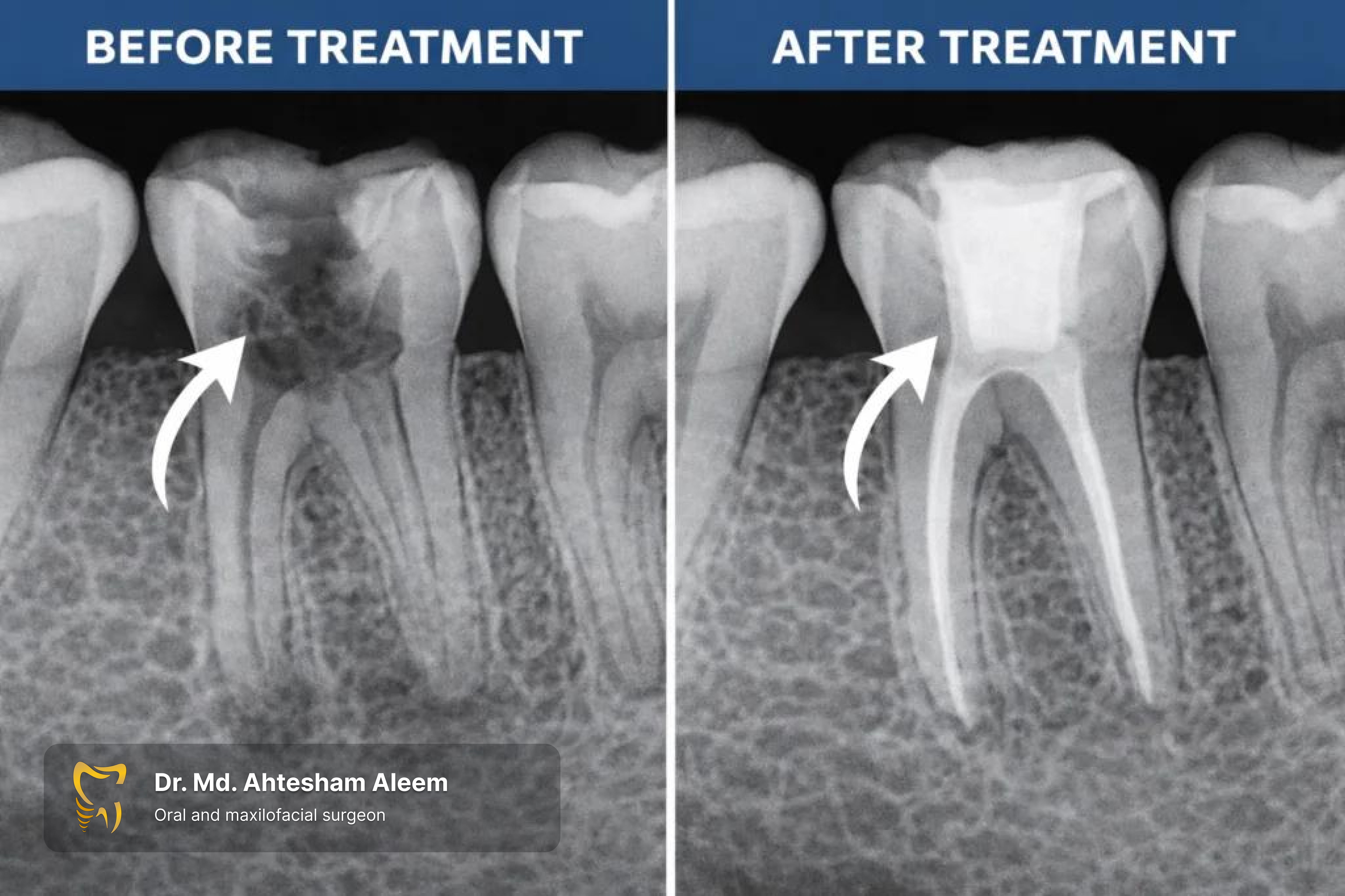 Root Canal Treatment Gallery 1