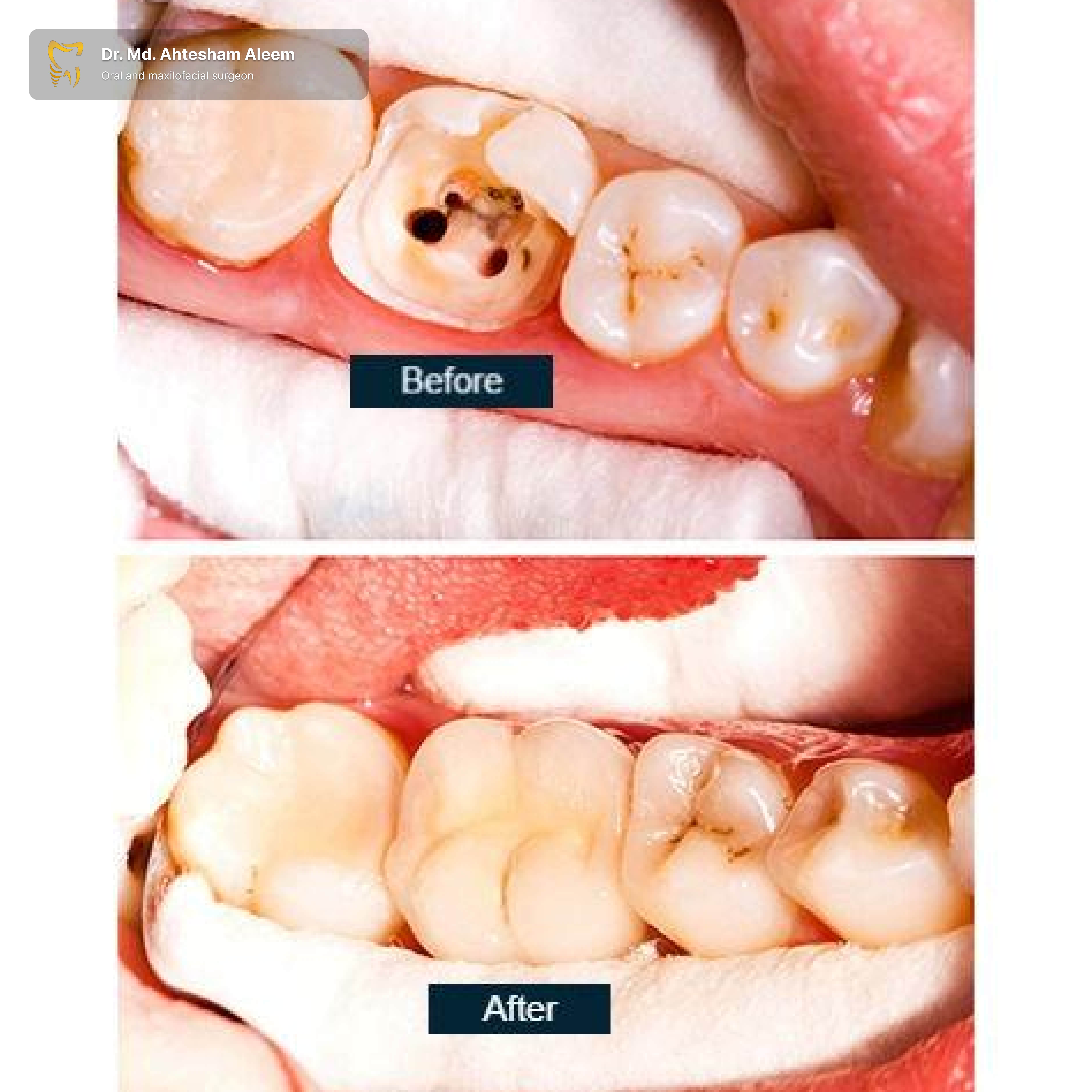 Root Canal Treatment Gallery 2