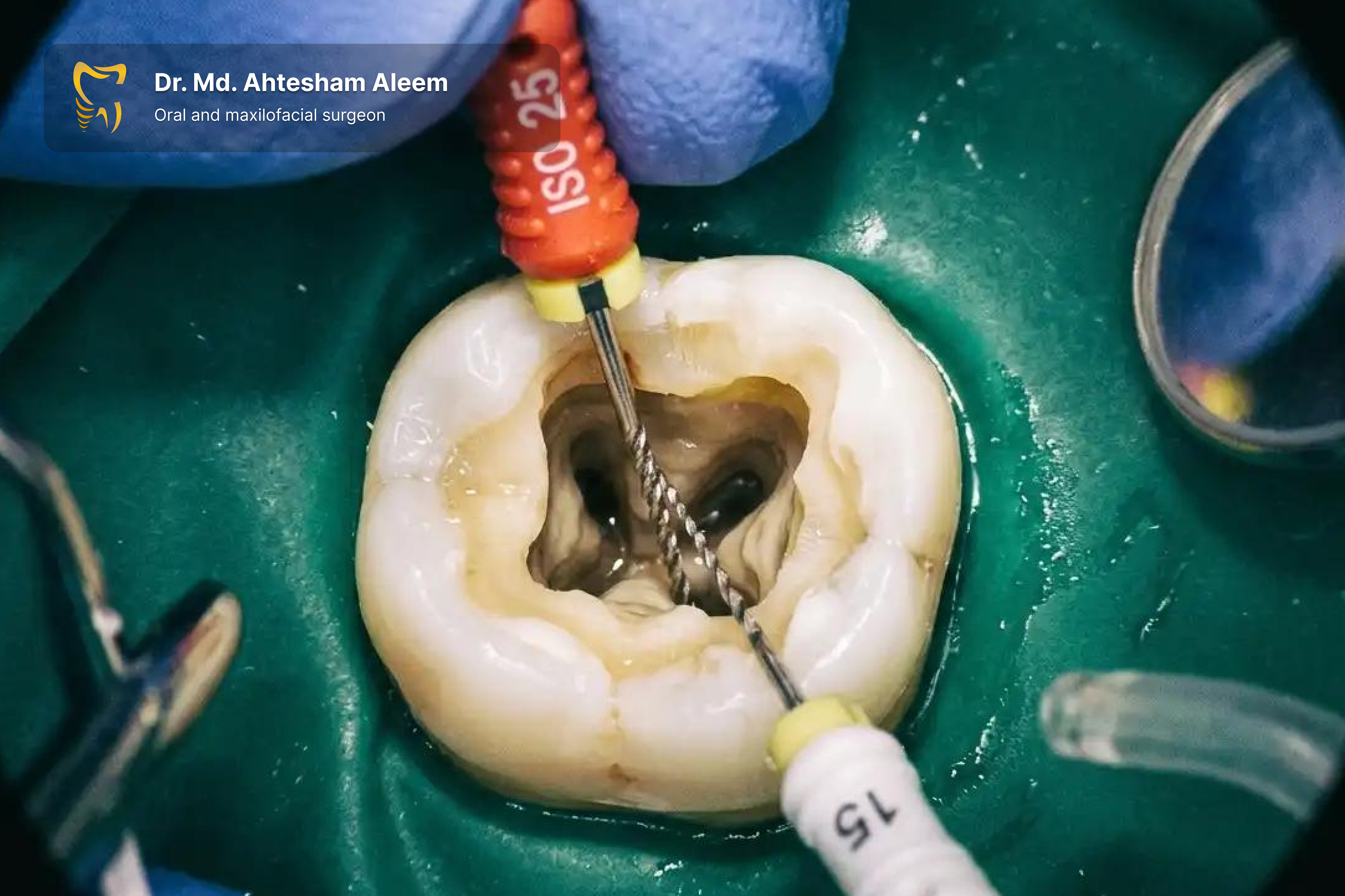 Root Canal Treatment Gallery 3