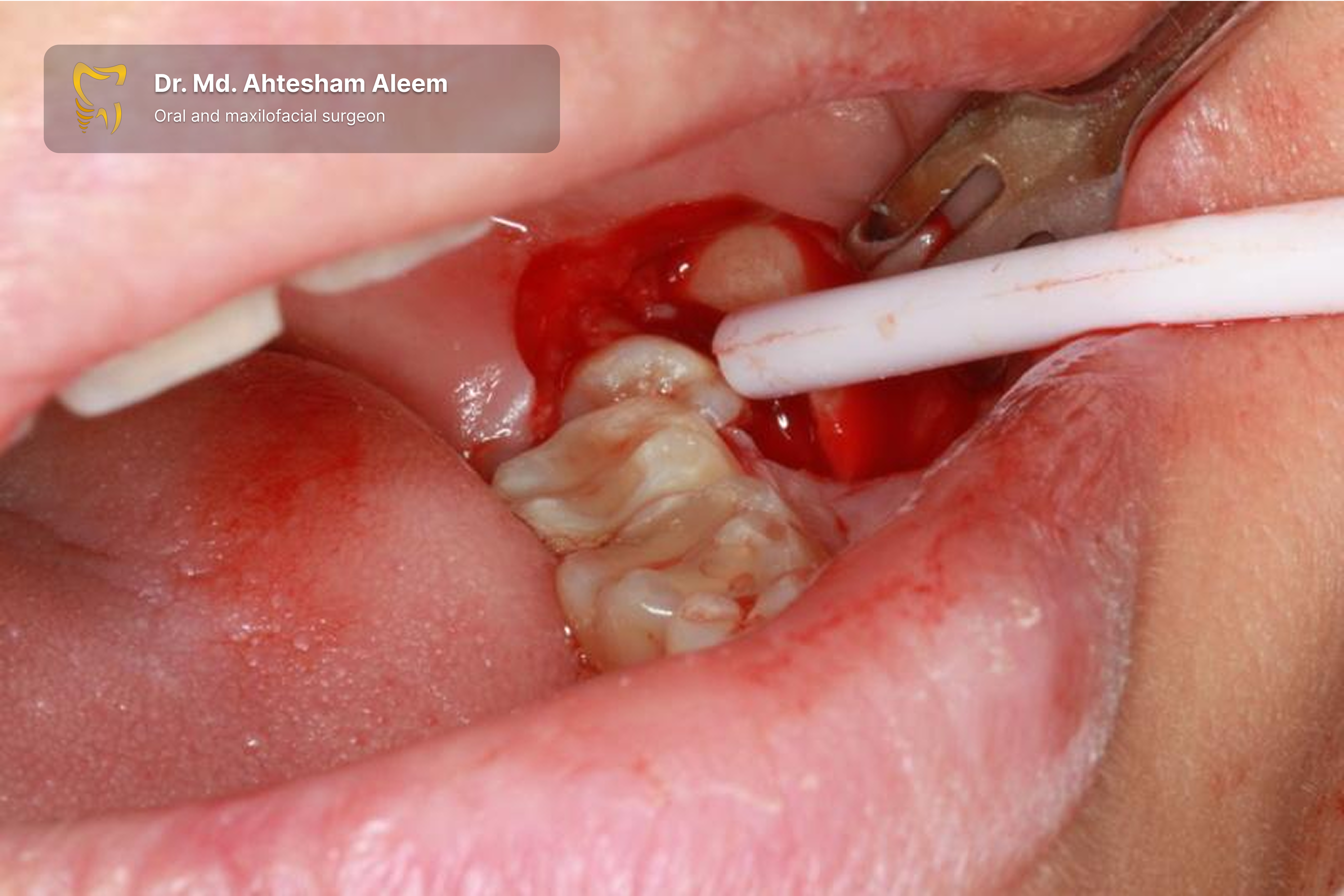 Impacted Tooth Surgery Gallery 1